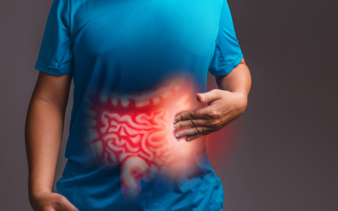 Colon Cancer